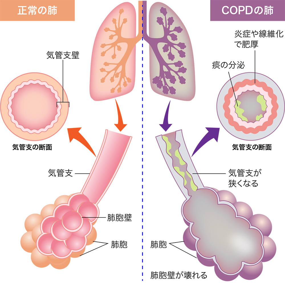 Copd ある ある